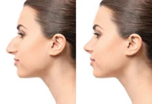 bump on nose treatments